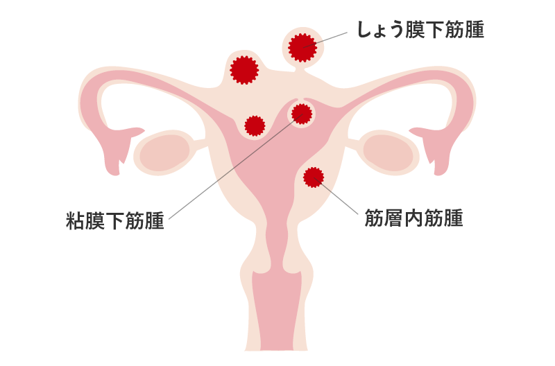 子宮筋腫の症状。