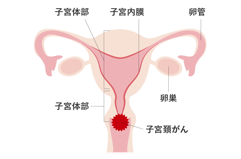 子宮頚がんとは。