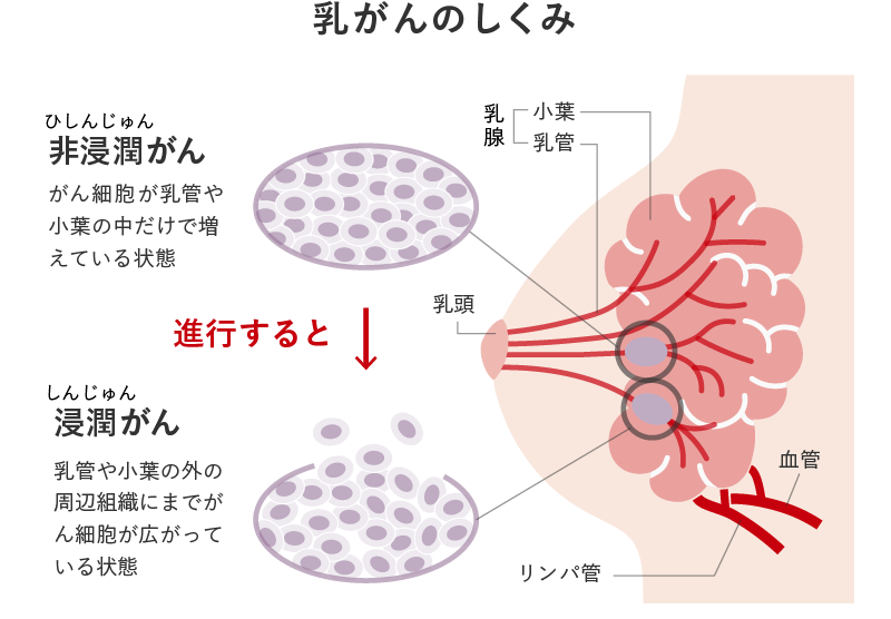 乳がんのしくみ