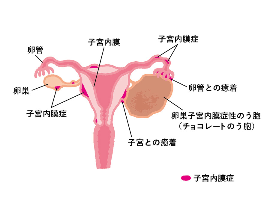 子宮内膜症の図解