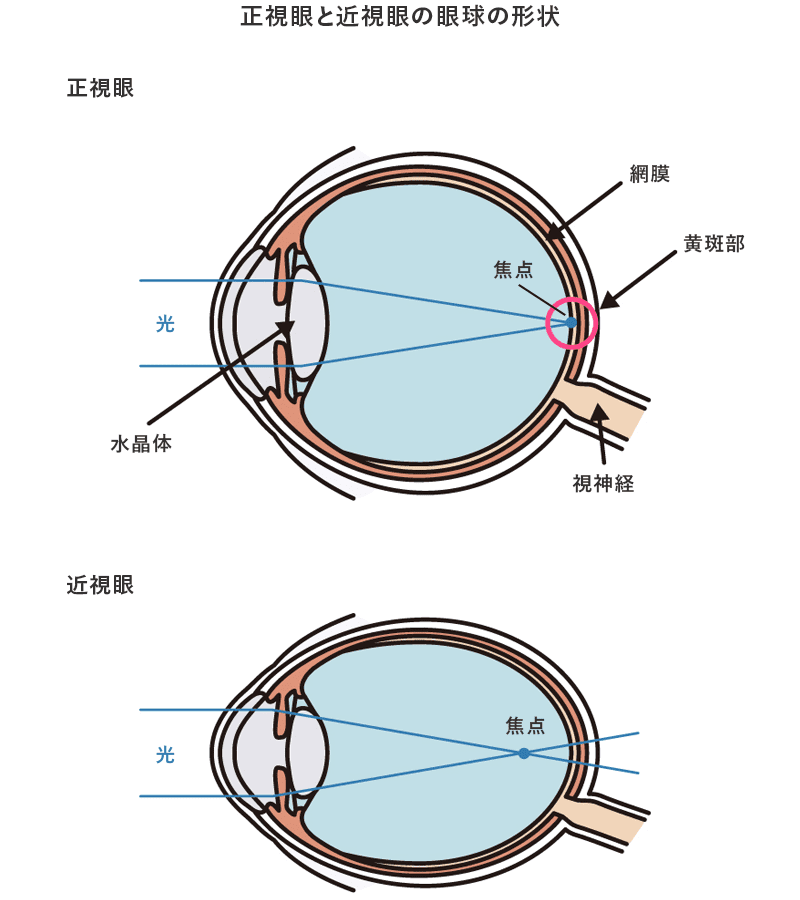 正視眼と近視眼の眼球の形状