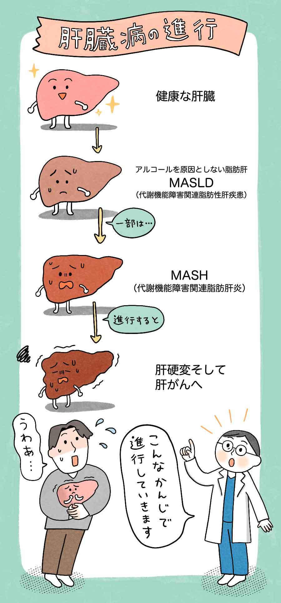 肝臓が、MASLDやMASH、肝硬変、肝がんへ進行していく説明。